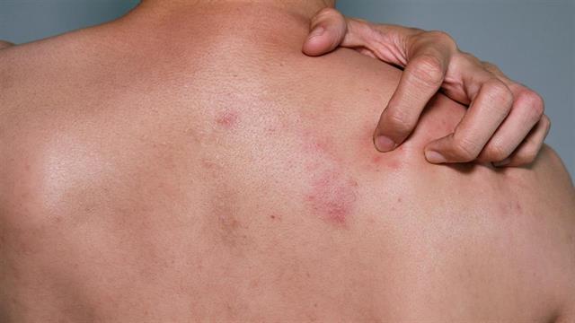 Πόσο απειλούνται από τον έρπητα ζωστήρα οι άνω των 50 και οι ανοσοκατεσταλμένοι - Πόσο προστατεύονται από νέο εμβόλιο