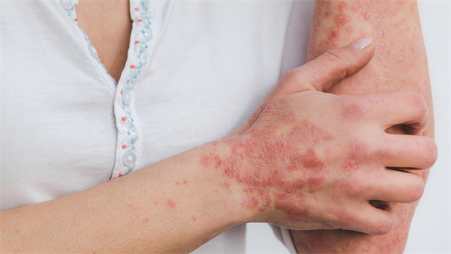 Μελέτη τριετίας για  τη μέτρια έως σοβαρή ψωρίαση κατά πλάκας