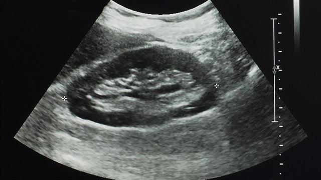 ΕΜΑ: Συστάσεις για άτομα με ηπατονεφρικό σύνδρομο που λαμβάνουν τερλιπρεσίνη