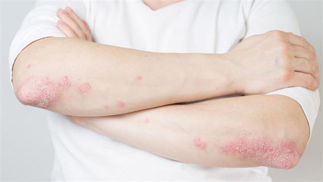 Πραγματοποιήθηκε η ημερίδα  Ψωρίαση και Δερματικά Νοσήματα 2022