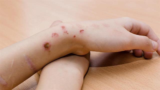 Οριακή διαταραχή προσωπικότητας: Όσα πρέπει να γνωρίζετε