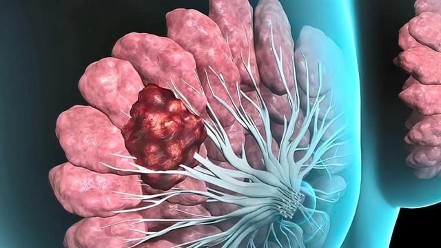 Αντιμετώπιση του καρκίνου του μαστού σήμερα