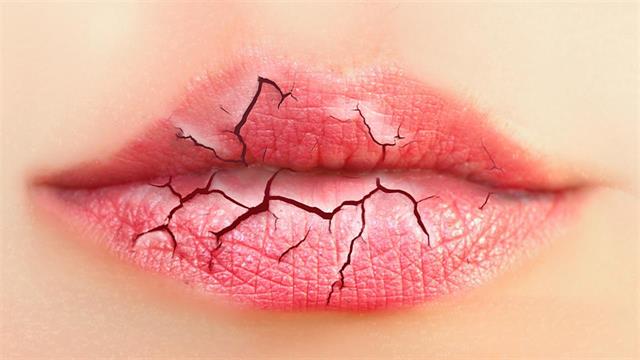 Σκασμένα χείλη: Όσα πρέπει να ξέρετε
