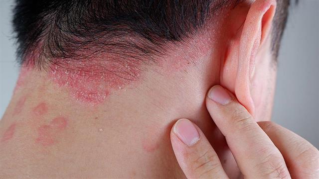 Ψωρίαση: Ποιες είναι οι σύγχρονες θεραπείες της νόσου;