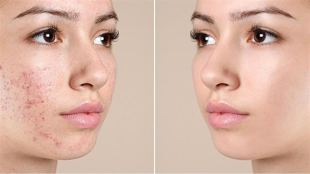 Ακμή: Mία νόσος, πολλοί μύθοι