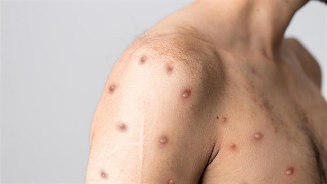 Ο ΠΟΥ σχεδιάζει να ανακοινώσει νέο όνομα για την ευλογιά των πιθήκων