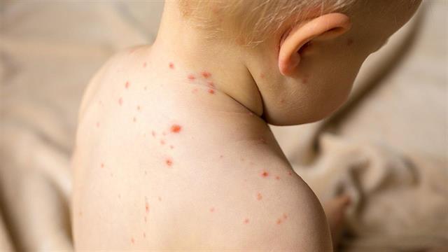 ΠΟΥ: Εκατομμύρια παιδιά είναι ευάλωτα στην ιλαρά