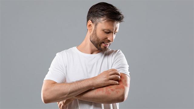 Μύθοι για το έκζεμα