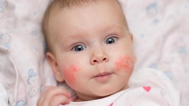 Aτοπική δερματίτιδα: Η συχνότερη χρόνια δερματοπάθεια των παιδιών