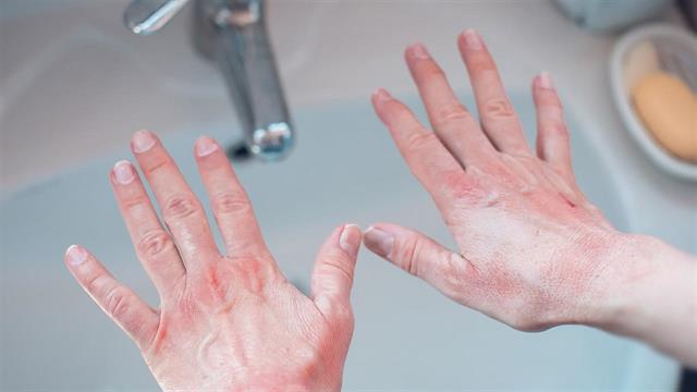 Νέα δεδομένα για  θεραπεία σε ενήλικες ασθενείς με μέτριο έως σοβαρό χρόνιο έκζεμα άκρας χειρός (CHE)