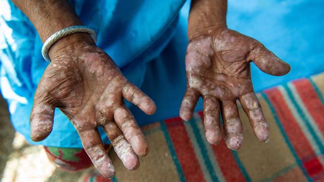 Η λέπρα εξακολουθεί να απειλεί