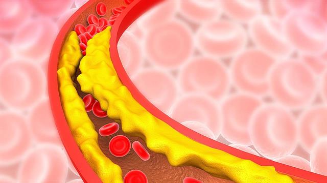 Εντοπίστηκαν γονίδια υπεύθυνα για τη στεφανιαία νόσο
