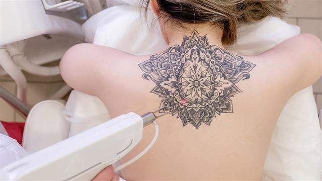 Αφαίρεση τατουάζ: Γιατί είναι τώρα η πιο κατάλληλη εποχή;