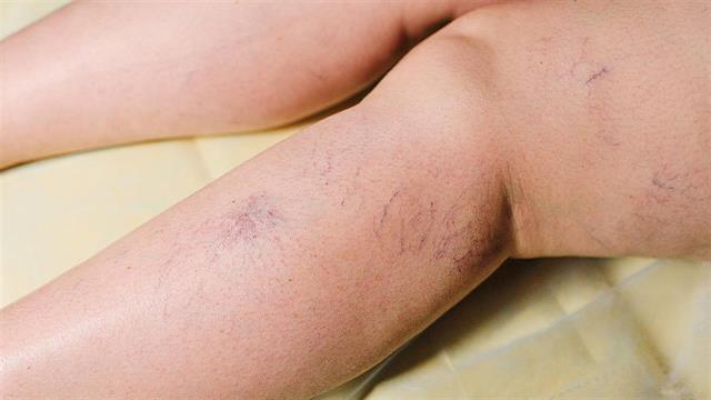 Ευρυαγγείες κάτω άκρων στις γυναίκες: Πρόληψη και θεραπεία