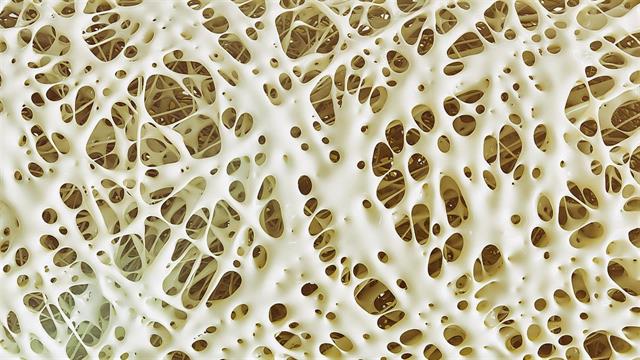 Πώς θα προλάβουμε την οστεοπόρωση