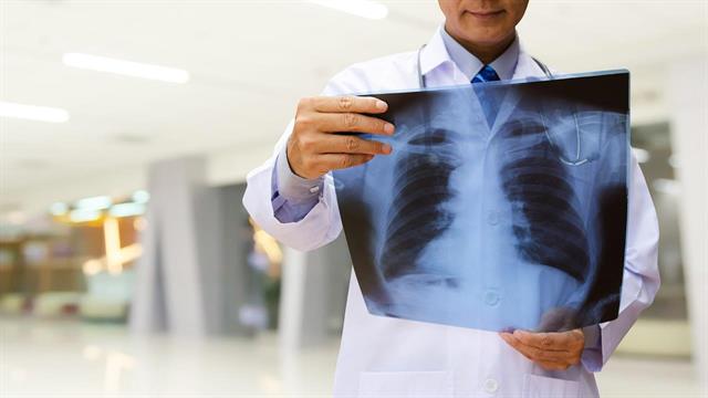 Στο τραπέζι το screening που σώζει ζωές στον καρκίνο του πνεύμονα