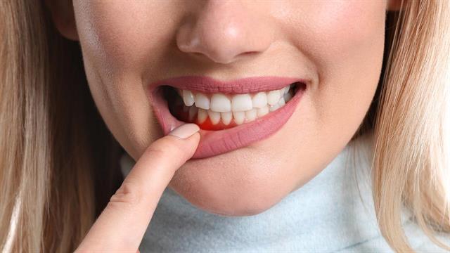 Πώς θα προλάβουμε τις παθήσεις των ούλων