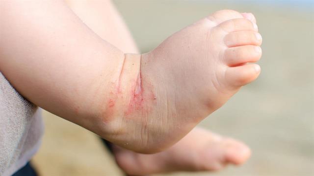 Εγκρίθηκε από την ΕΕ το πρώτο και μοναδικό φάρμακο για τη σοβαρή ατοπική δερματίτιδα σε παιδιά
