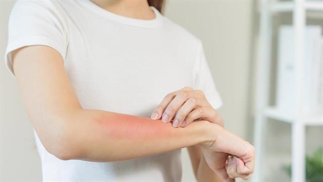 Η ατοπική δερματίτιδα συνδέεται με αυξημένο κίνδυνο καρκίνου στο δέρμα [μελέτη]