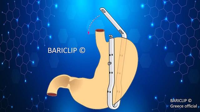 Κλιπ στο στομάχι: Η Νέα λαπαροσκοπική και αποτελεσματική μέθοδος αδυνατίσματος