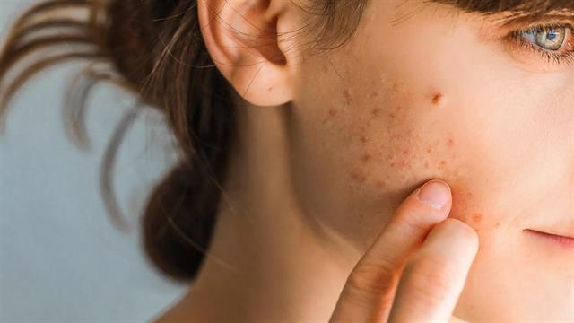 Πώς επηρεάζεται το δέρμα από τη διάθεσή μας;