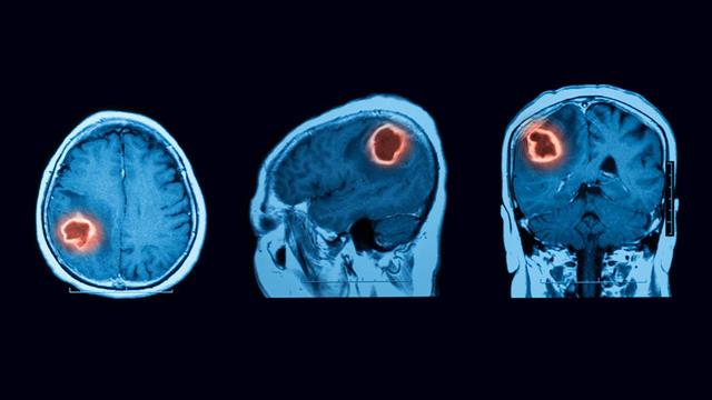 Πώς η υπέρταση μπορεί να οδηγήσει σε εγκεφαλική βλάβη