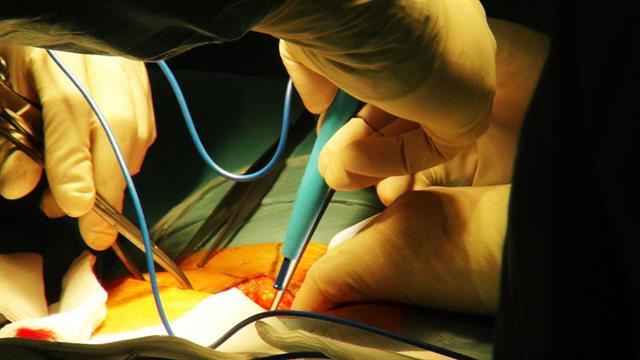 ΑΠΘ: Εξιτήριο στον μισό χρόνο μετά από μεταμόσχευση ήπατος