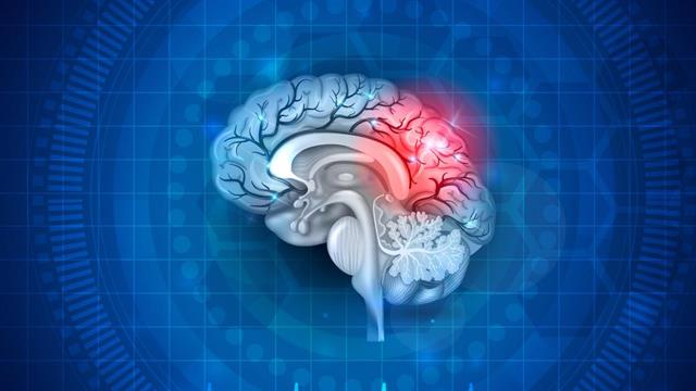 Γνωστική εξασθένηση και άνοια: Συχνές μετά από εγκεφαλικό επεισόδιο