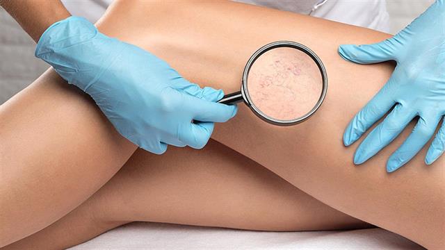 Πότε το Ενδοαυλικό Laser πρέπει να προηγείται της σκληροθεραπείας των ευρυαγγειών;