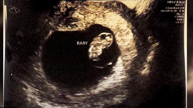 Βοστώνη: Γιατροί έκαναν επέμβαση εγκεφάλου σε μωρό, πριν γεννηθεί [βίντεο]