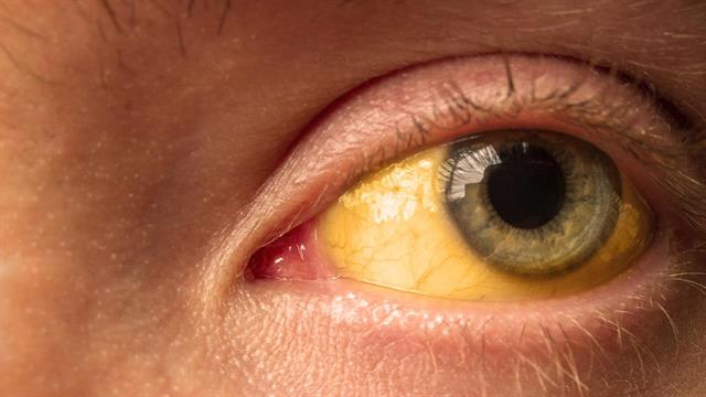 ΗΠΑ: Ο καρκίνος στο πάγκρεας αυξάνεται σε νέες γυναίκες