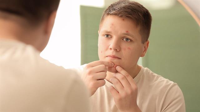 Ακμή στην προεφηβεία: Ποιος είναι ο ρόλος του σωματικού βάρους;