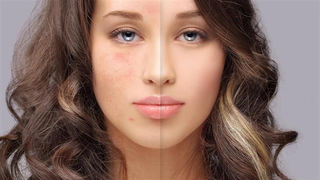 Κυστική ακμή και ουλές: Αντιμετώπιση με εξατομικευμένες θεραπείες