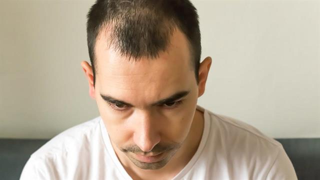 Τριχόπτωση σε άντρες: Τι την προκαλεί