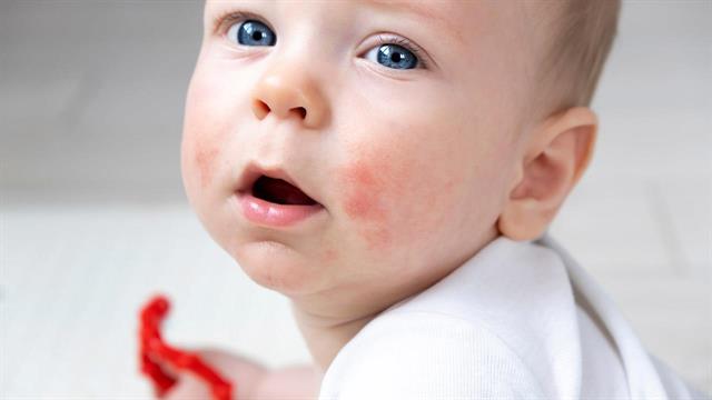 Νέα θεραπεία για τους ασθενείς με σύνδρομο Alagille