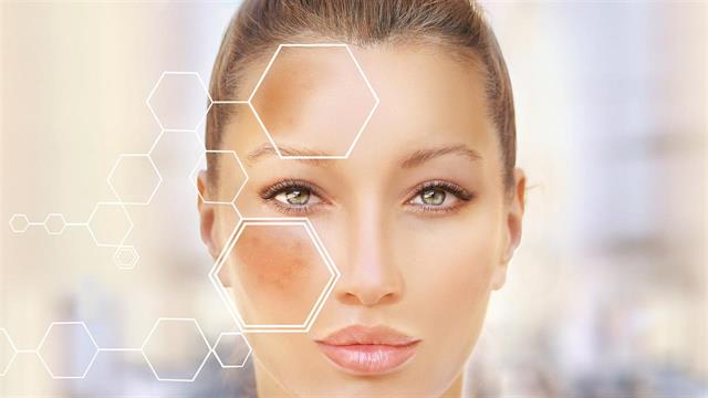 Μέλασμα: Τι είναι και τι το προκαλεί;