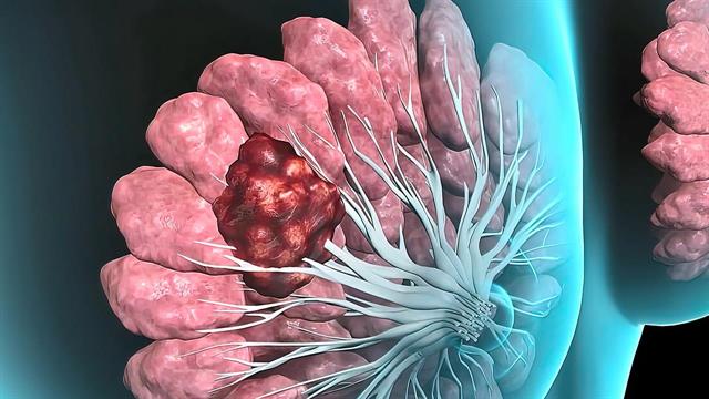 Γυναίκες με μηνιγγίωμα μπορεί να έχουν δεκαπλάσιο κίνδυνο για καρκίνο μαστού