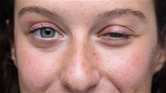 Η Ελλάδα μια από 14 χώρες στις οποίες θα κυκλοφορήσει νέο φάρμακο για τη  μυασθένεια Gravis