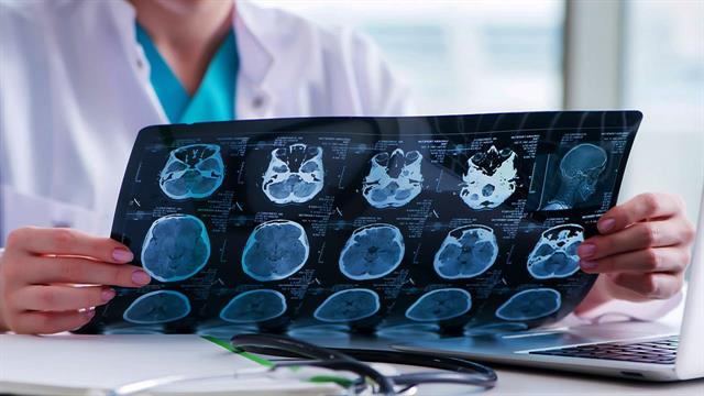 Φάρμακο της Eli Lilly επιβράδυνε κατά 35% τη νόσο Αλτσχάιμερ