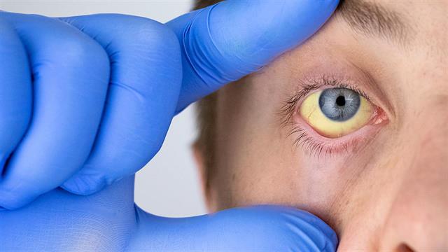 Ηπατίτιδα Β και C: Οι 300.000 Ελληνες πάσχοντες και ο στόχος της εκρίζωσης