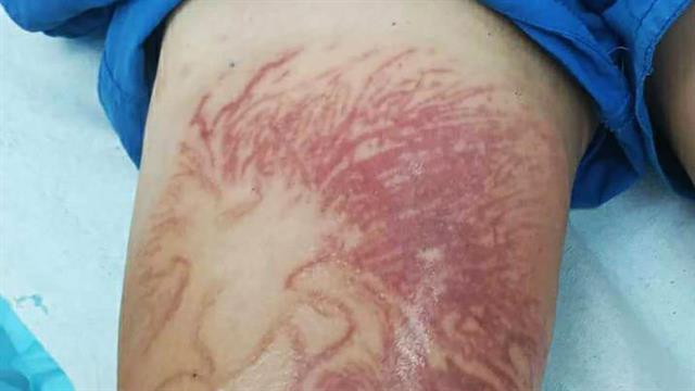 Στο νοσοκομείο 9χρονος που δέχτηκε τσίμπημα απο θαλάσσια ανεμώνη στο Καλαμάκι Κορινθίας