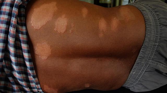 Η λέπρα θα μπορούσε να γίνει ενδημική στη Φλόριντα