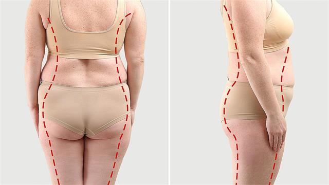 Λιπογλυπτική: Σμιλεύοντας τις ατέλειες του σώματος