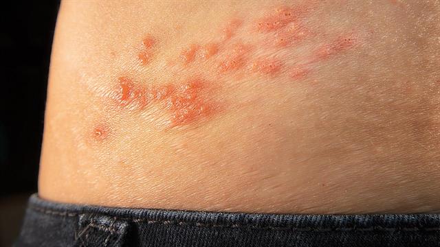 Νέο μόριο θα μπορούσε να αντιμετωπίζει τους ιούς του έρπητα ζωστήρα και του απλού έρπητα τύπου 1 και 2