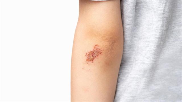 Νέα συσκευή θα μπορούσε να εντοπίζει πιο γρήγορα πληγές που έχουν μολυνθεί