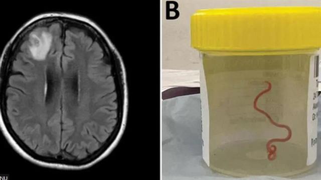Παγκόσμια πρωτιά: Ζωντανό σκουλήκι 8 εκατοστών σε εγκέφαλο γυναίκας