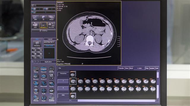 Βελτίωση της θεραπείας σε ασθενείς με οξύ έμφραγμα - Διεθνής μελέτη, με ελληνική συμμετοχή