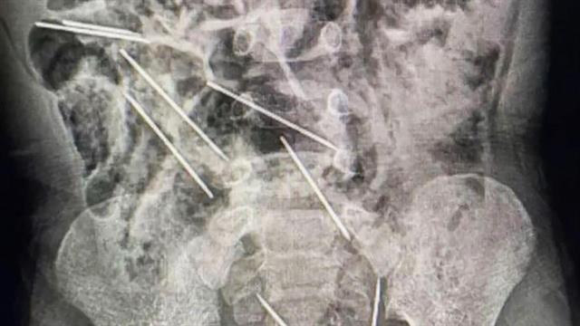 Αγόρι 2 ετών στο Περού κατάπιε οκτώ βελόνες - Σώθηκε έπειτα από επέμβαση