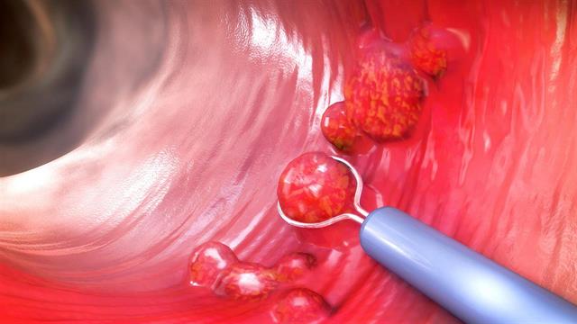 Οι 10 πιο συχνές ερωτήσεις για τους πολύποδες παχέος εντέρου