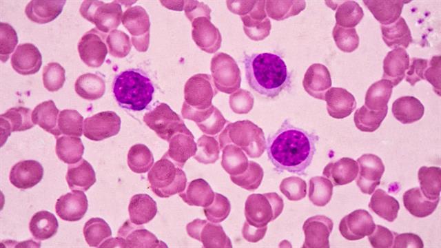 Τα κακοήθη αιματολογικά νοσήματα αποτελούν το 10% του συνόλου των κακοηθειών